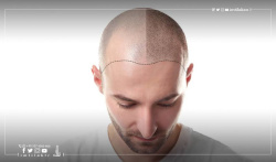 زراعة الشعر في تركيا - المميزات والأسعار وأهم المعلومات